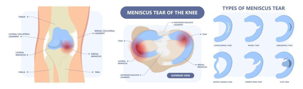 Meniscus tear diagram