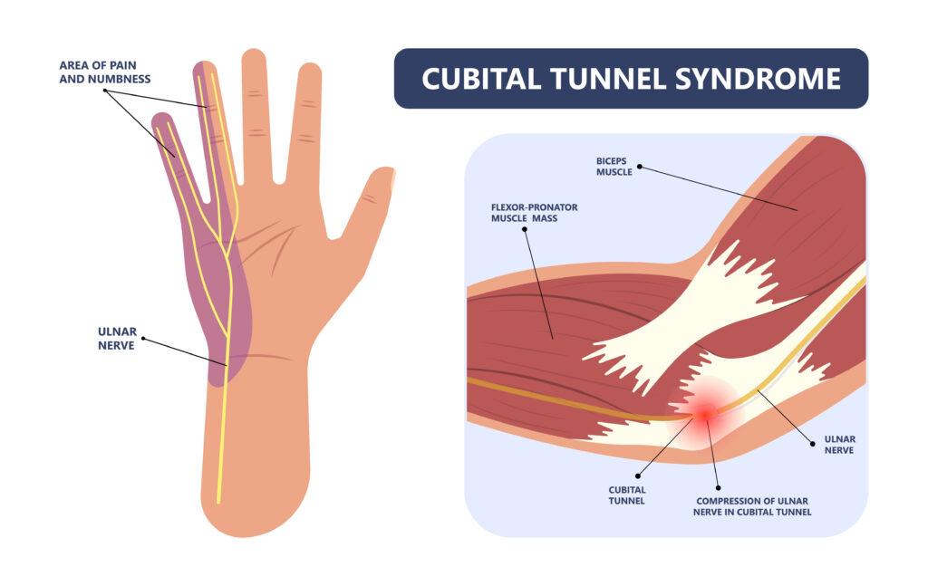 Cubital Tunnel Syndrome