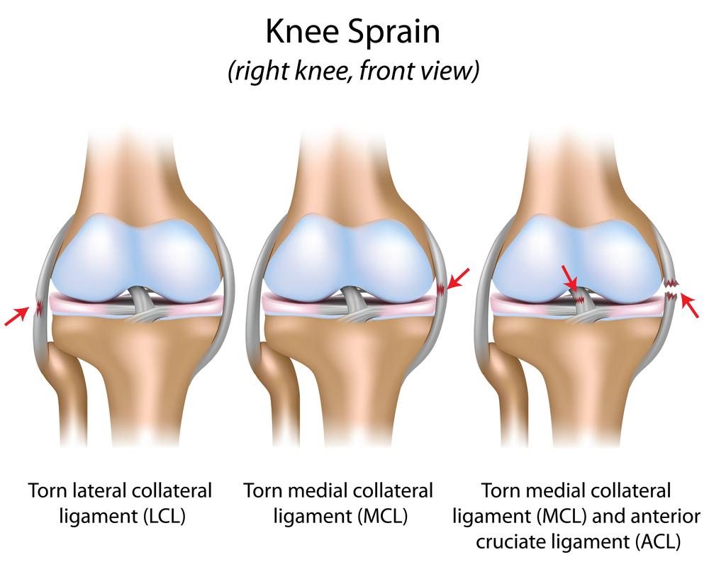 Knee sprain diagram